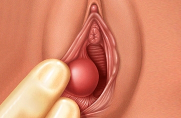 Bartholin Cyst